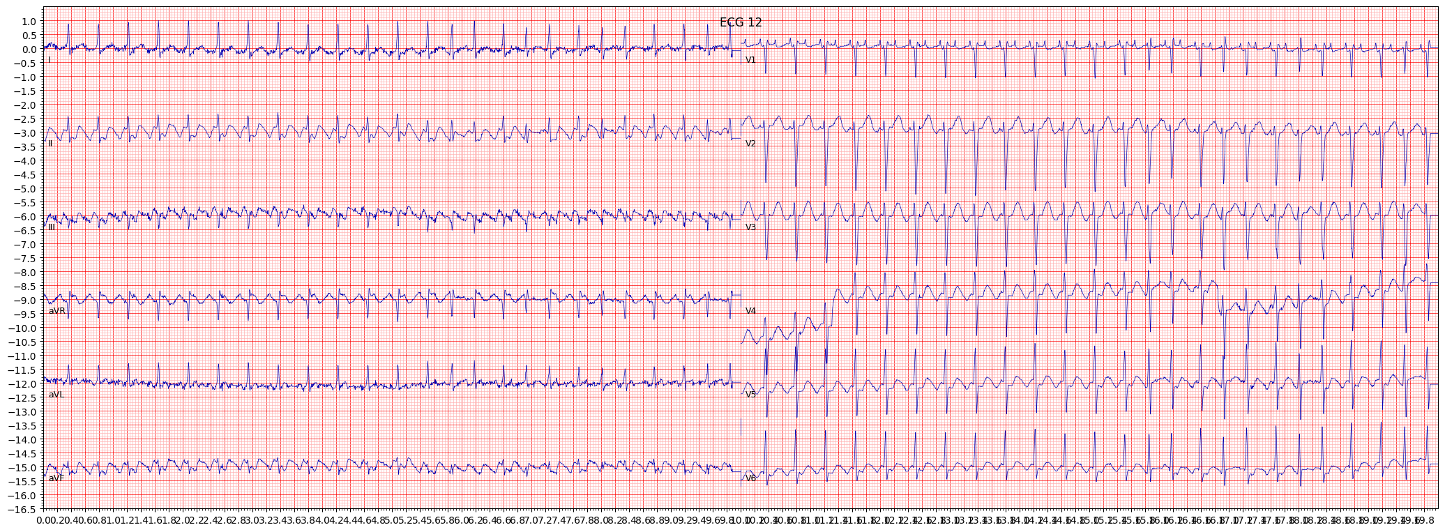 ECG example image