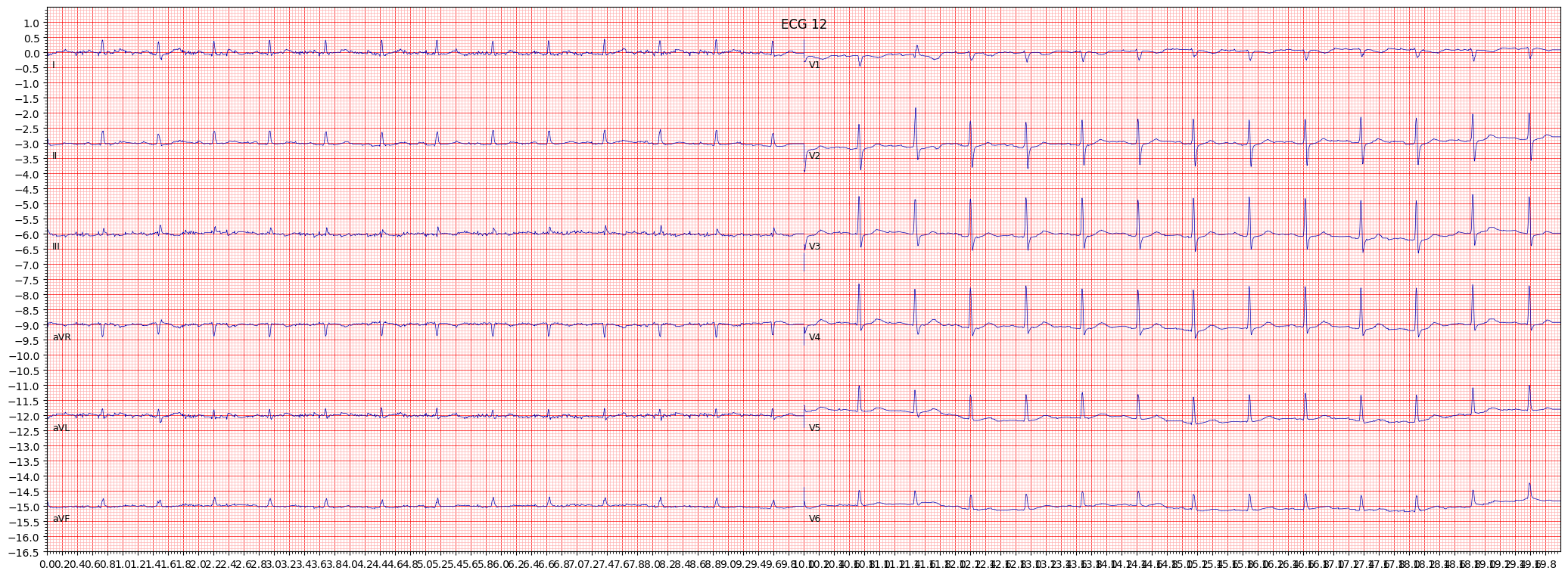 ECG example image