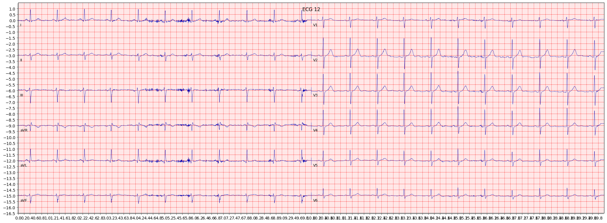 ECG example image