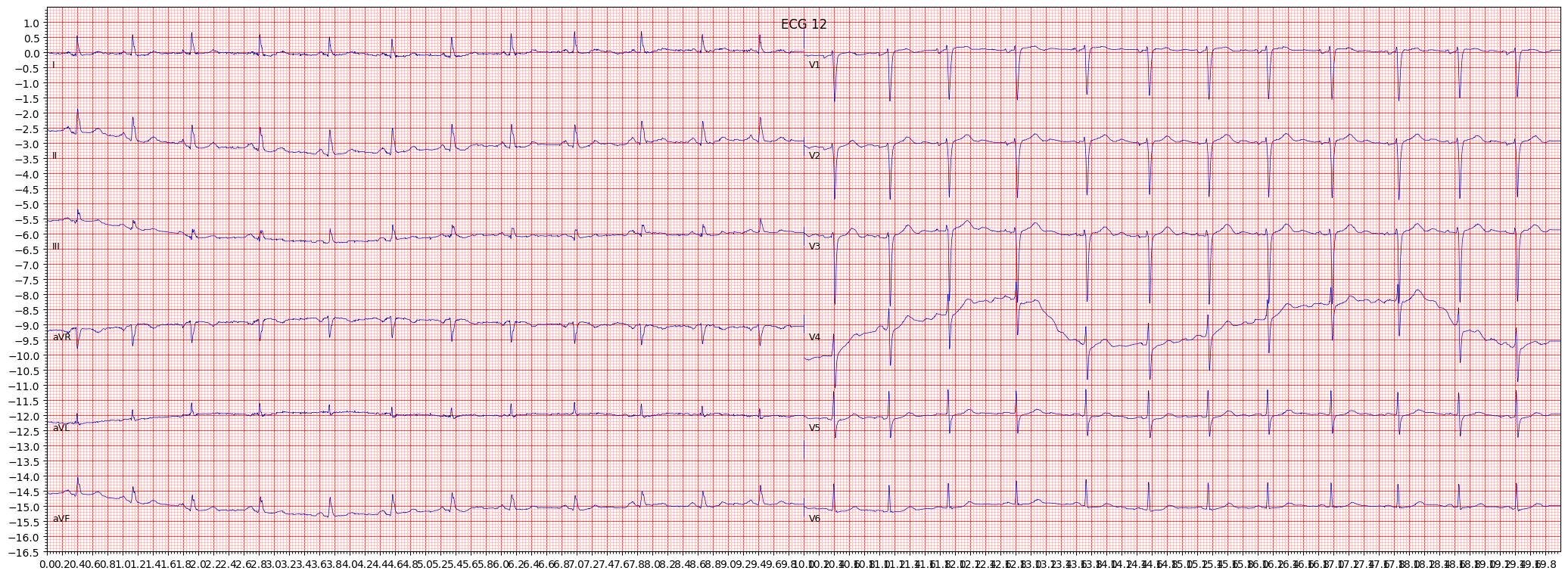 ECG example image