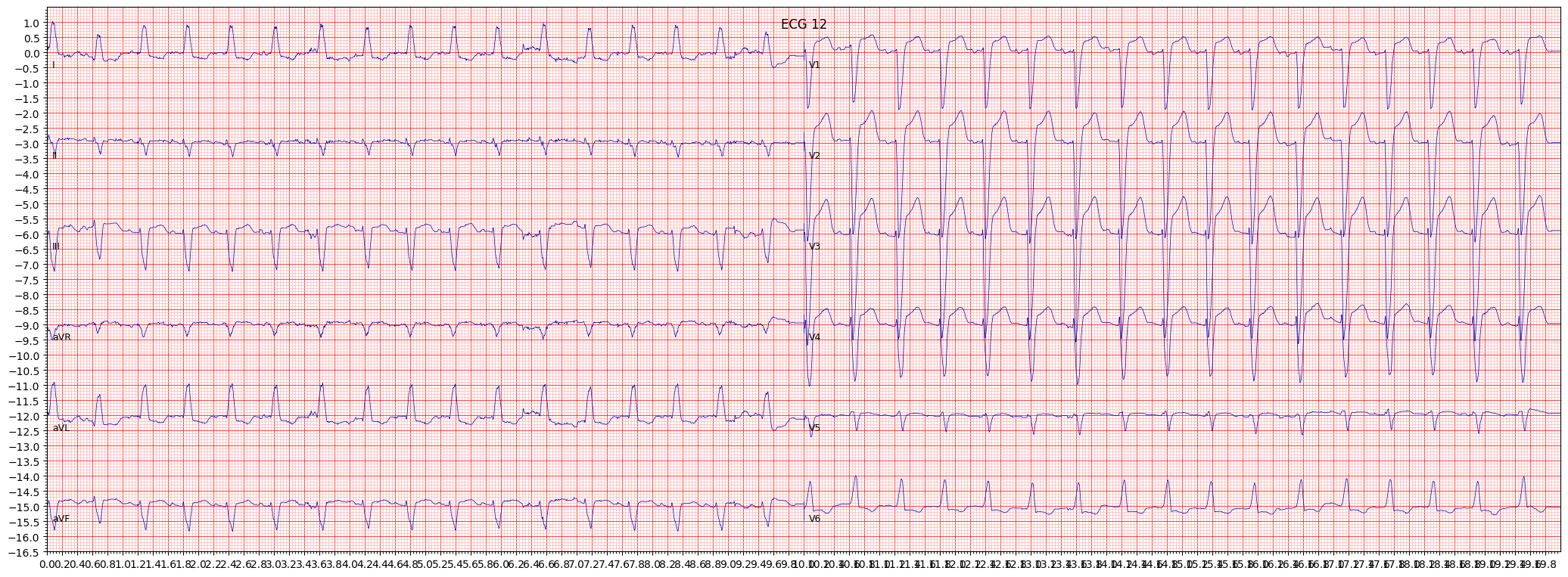 ECG example image
