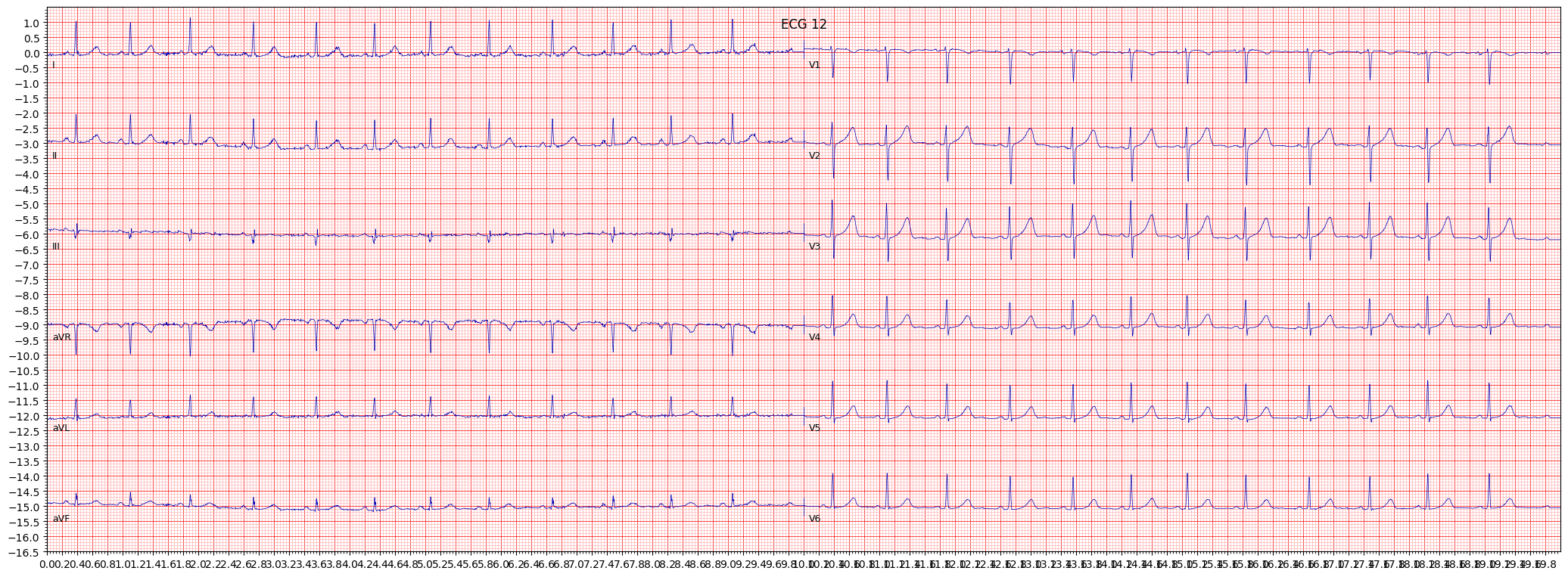 ECG example image