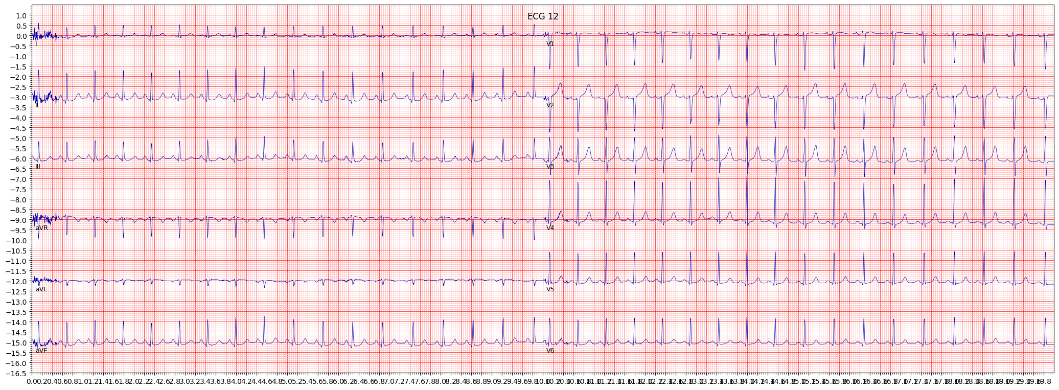 ECG example image