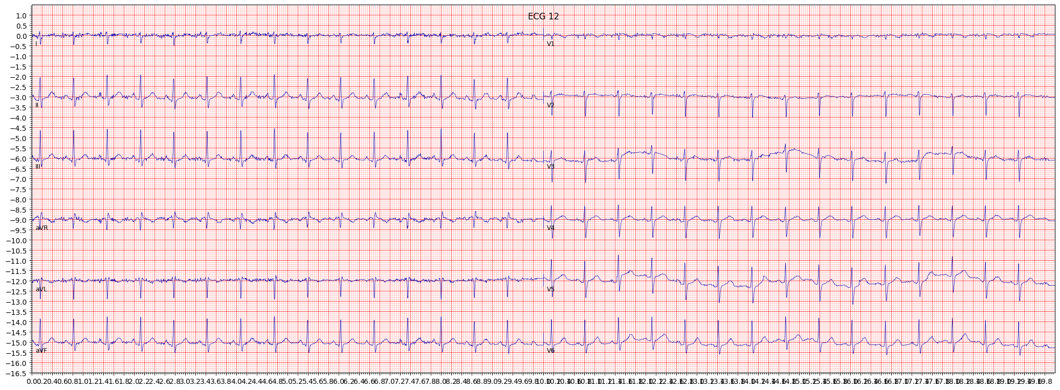 ECG example image