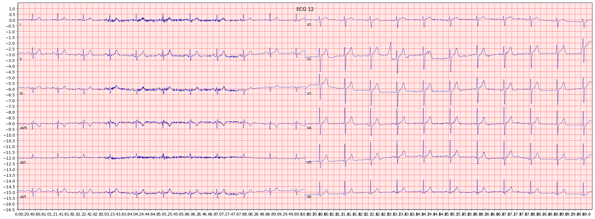 ECG example image