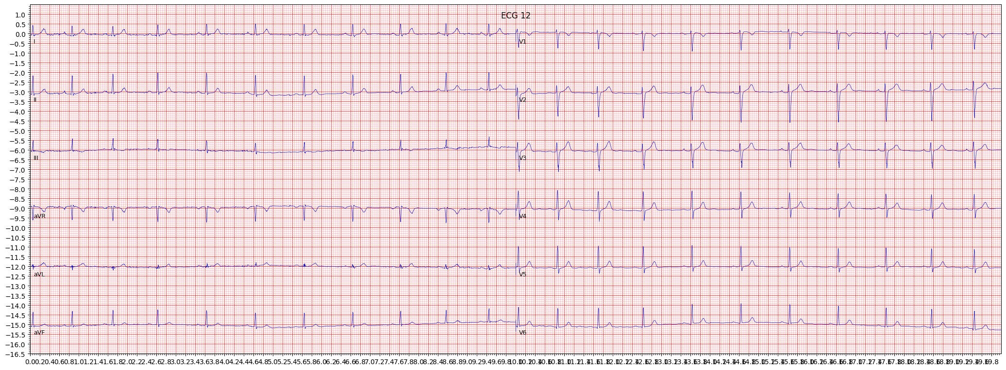 Normal ECG (NORM) example 10