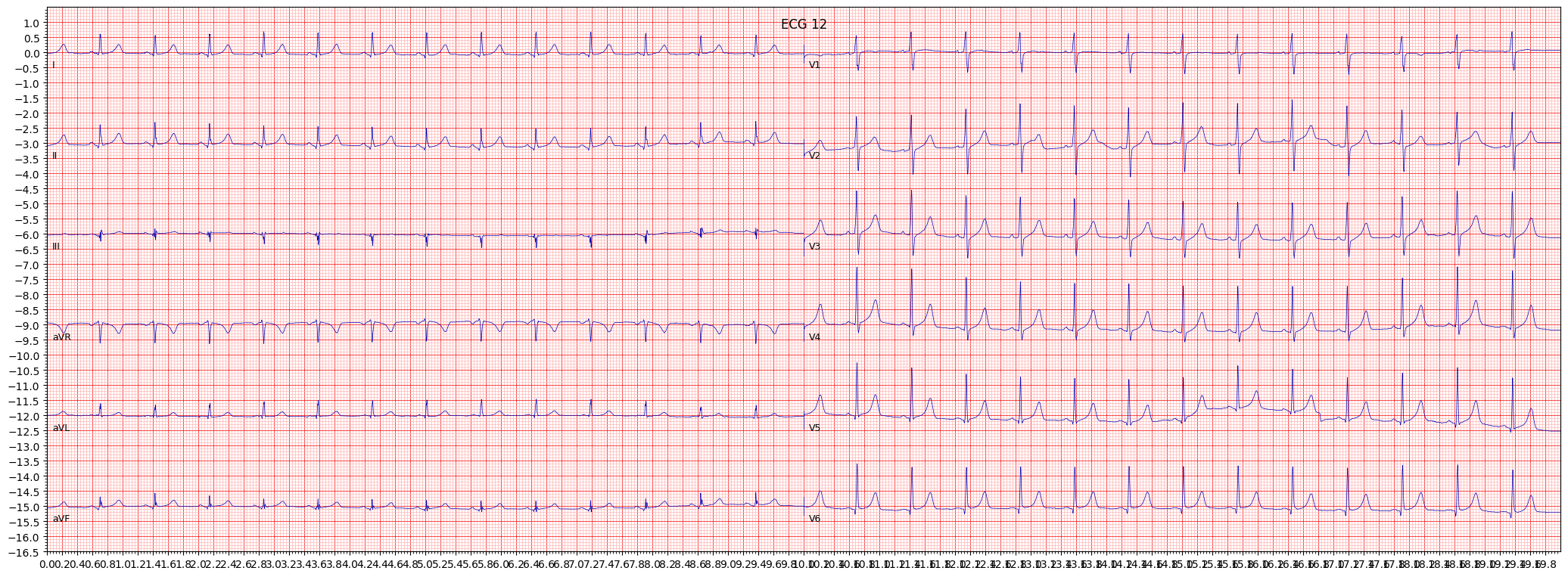 ECG example image