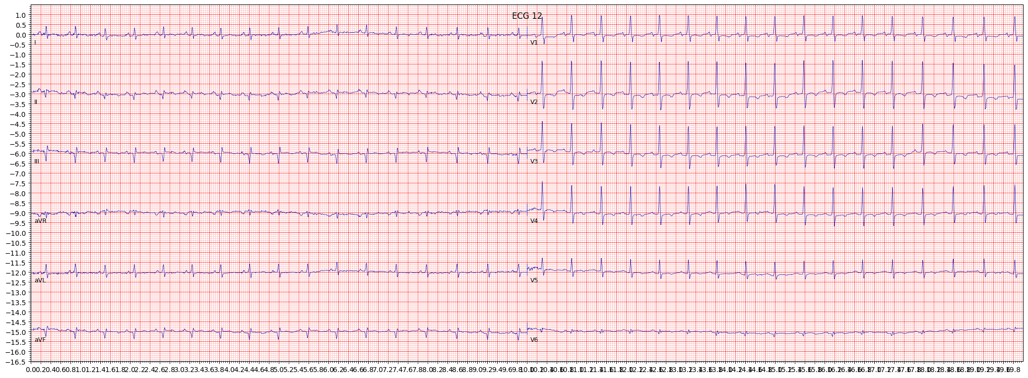 inferoposterolateral myocardial infarction (IPLMI) example 12173