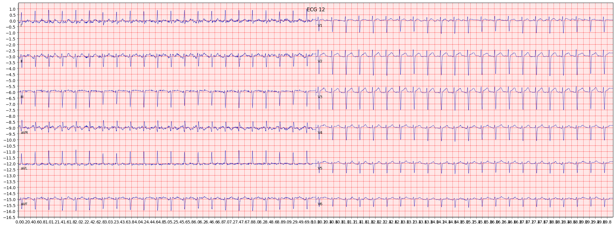paroxysmal supraventricular tachycardia (PSVT) example 12346