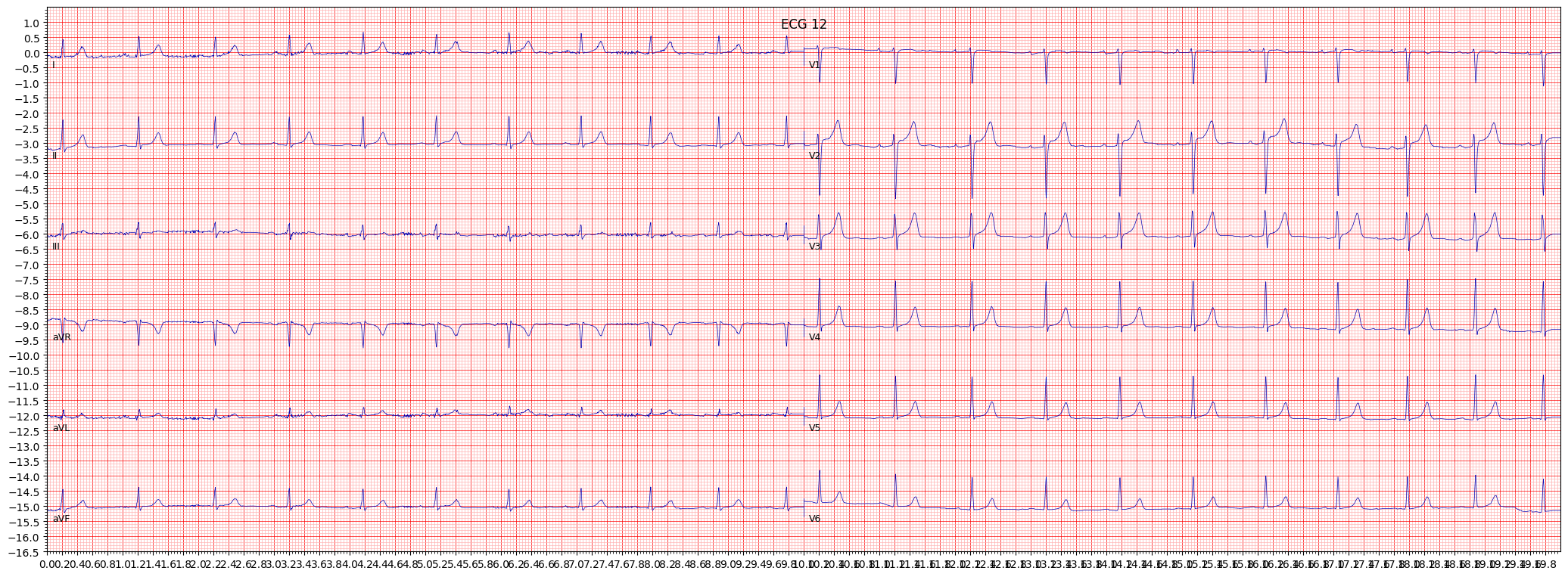 Normal ECG (NORM) example 124