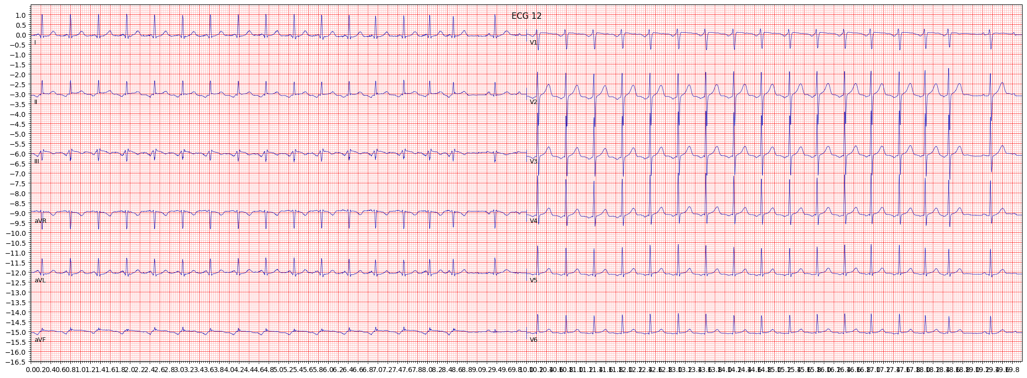 paroxysmal supraventricular tachycardia (PSVT) example 12489