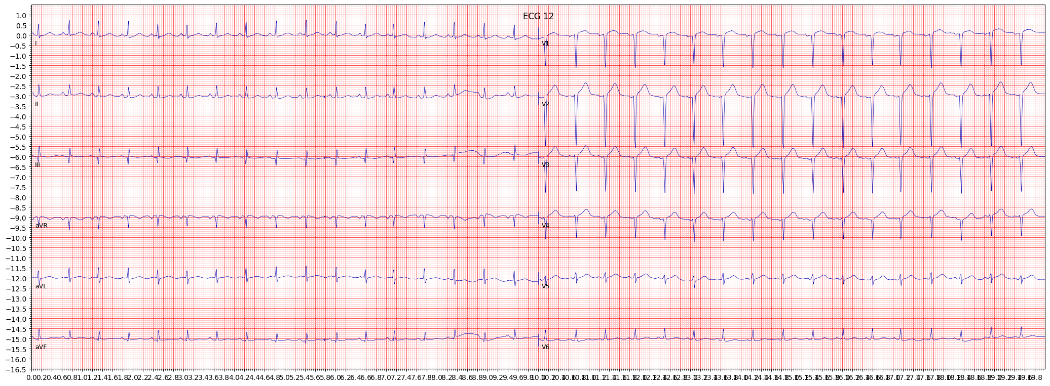 anteroseptal myocardial infarction (ASMI) example 1278