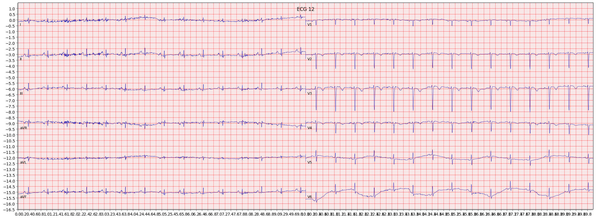 anteroseptal myocardial infarction (ASMI) example 1324