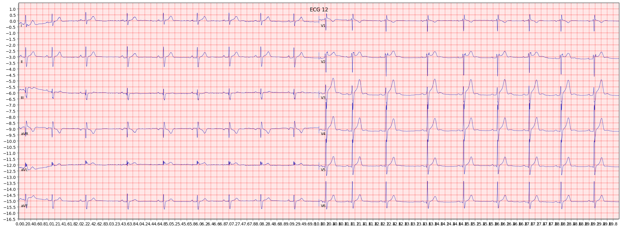 ECG example image