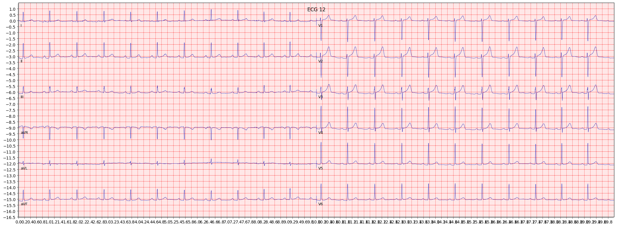 Normal ECG (NORM) example 136