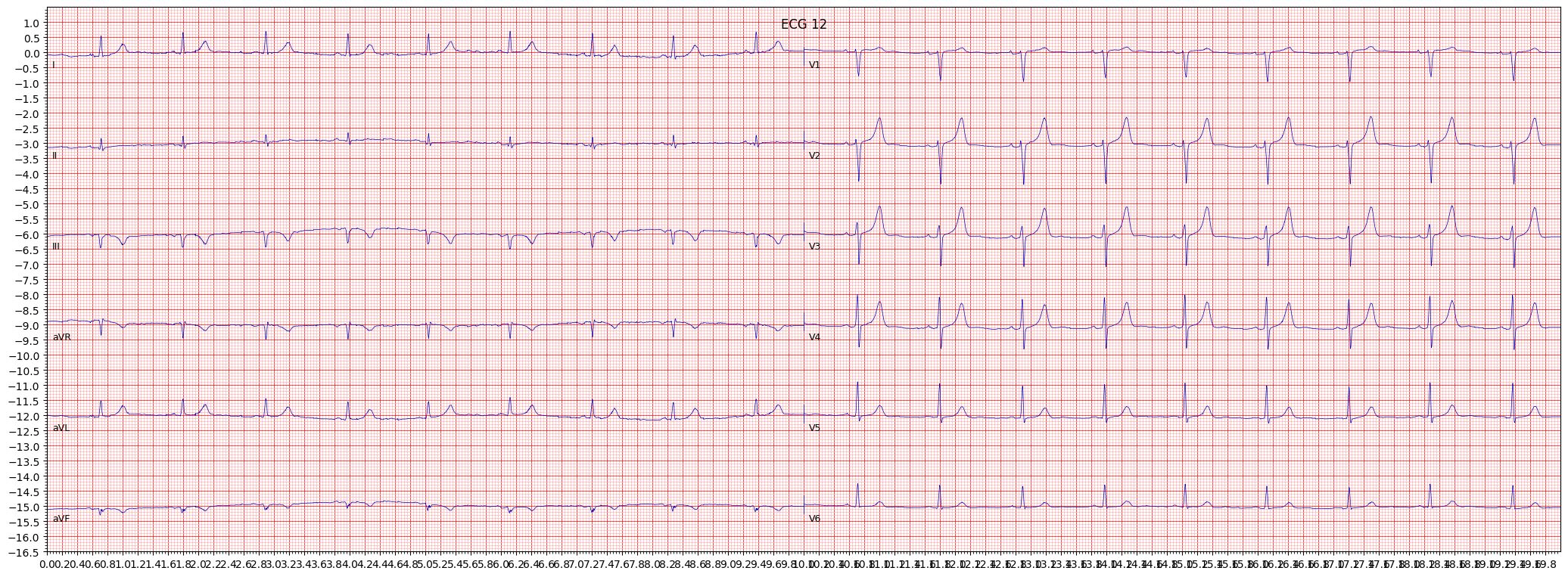 inferior myocardial infarction (IMI) example 1373