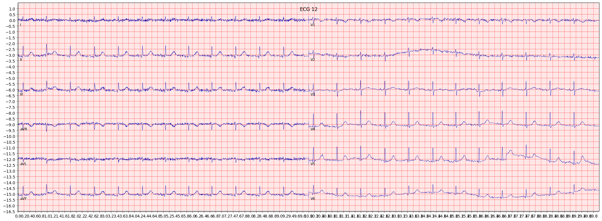ECG example image