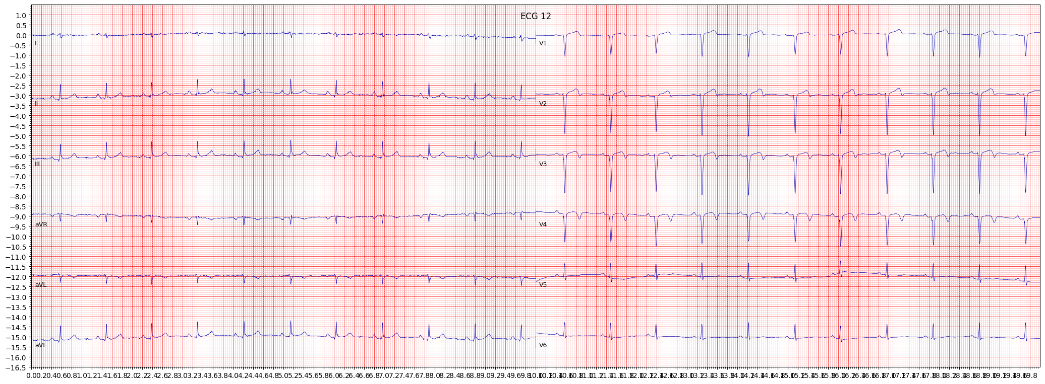 anteroseptal myocardial infarction (ASMI) example 1440