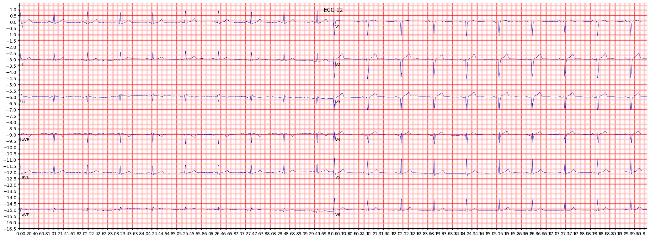 anteroseptal myocardial infarction (ASMI) example 1441