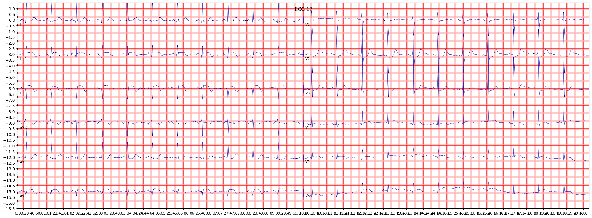 inferoposterolateral myocardial infarction (IPLMI) example 15130
