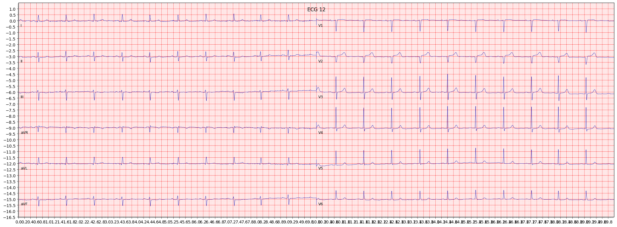 anterior myocardial infarction (AMI) example 15319