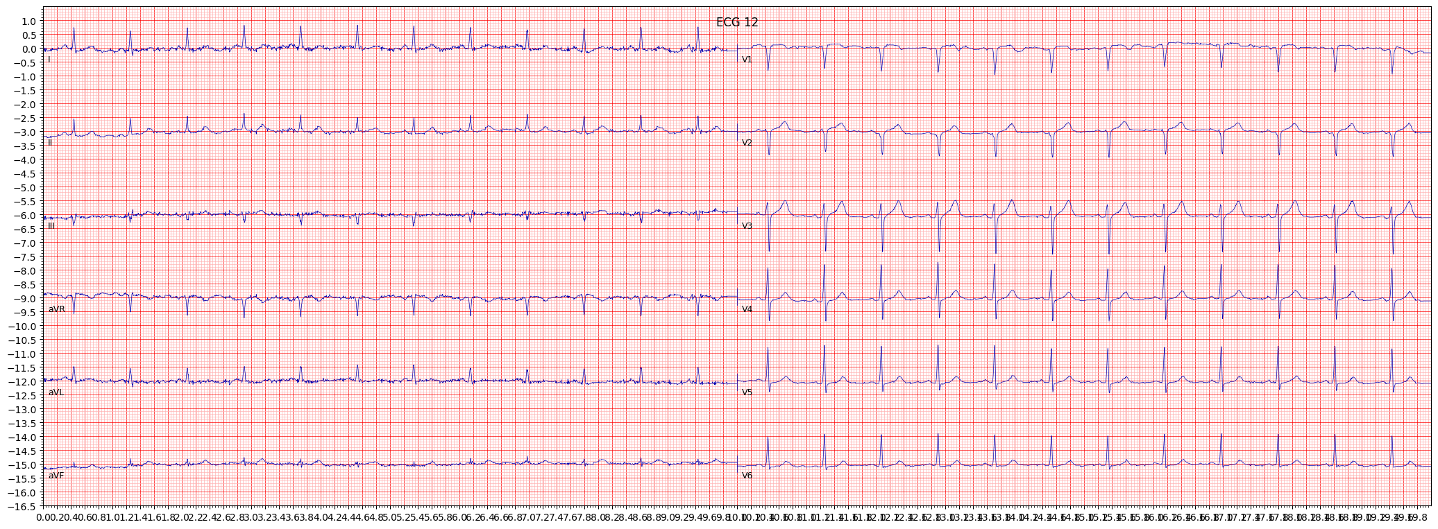 anterior myocardial infarction (AMI) example 15499
