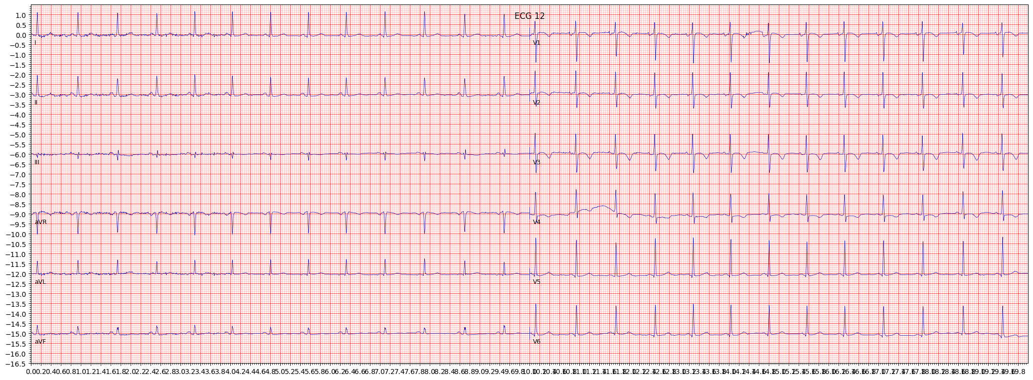subendocardial injury in anteroseptal leads (INJAS) example 15746