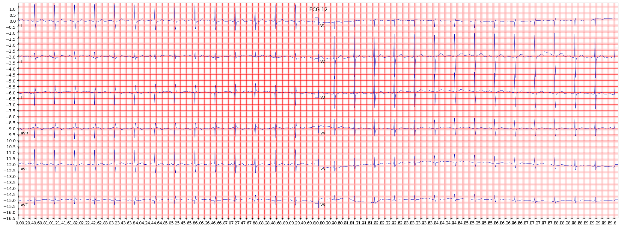 inferior myocardial infarction (IMI) example 1577