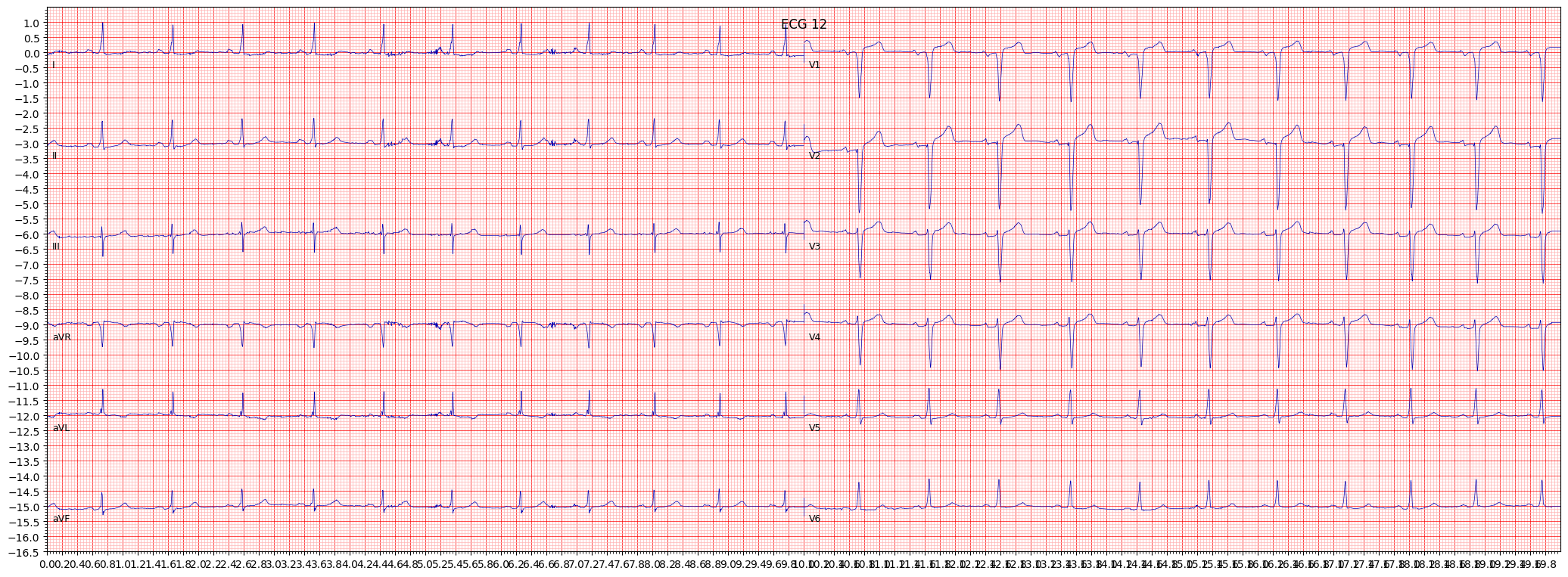 anterior myocardial infarction (AMI) example 15865