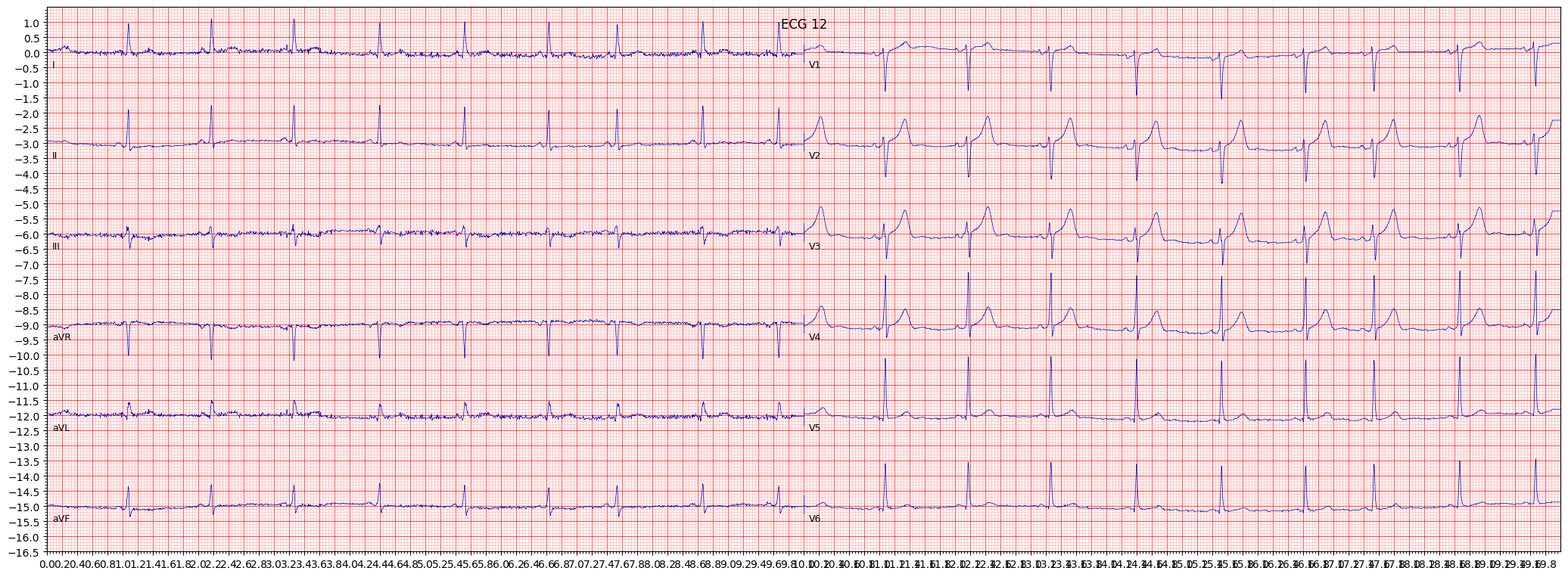 ECG example image