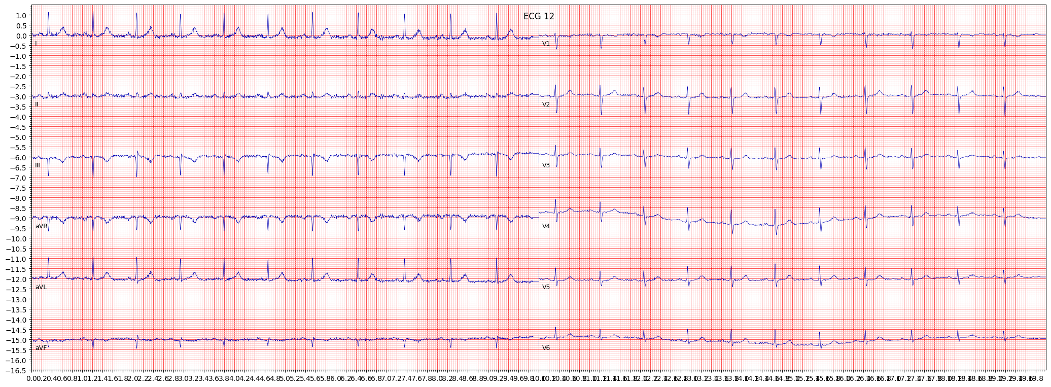 inferior myocardial infarction (IMI) example 1606