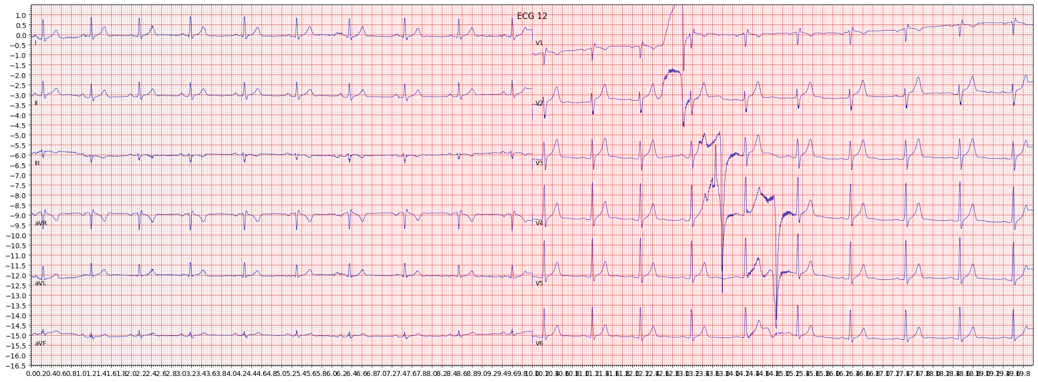 ECG example image