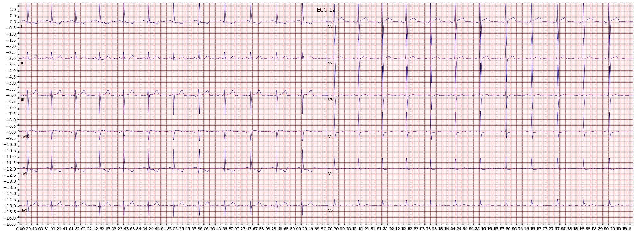 inferoposterolateral myocardial infarction (IPLMI) example 16521
