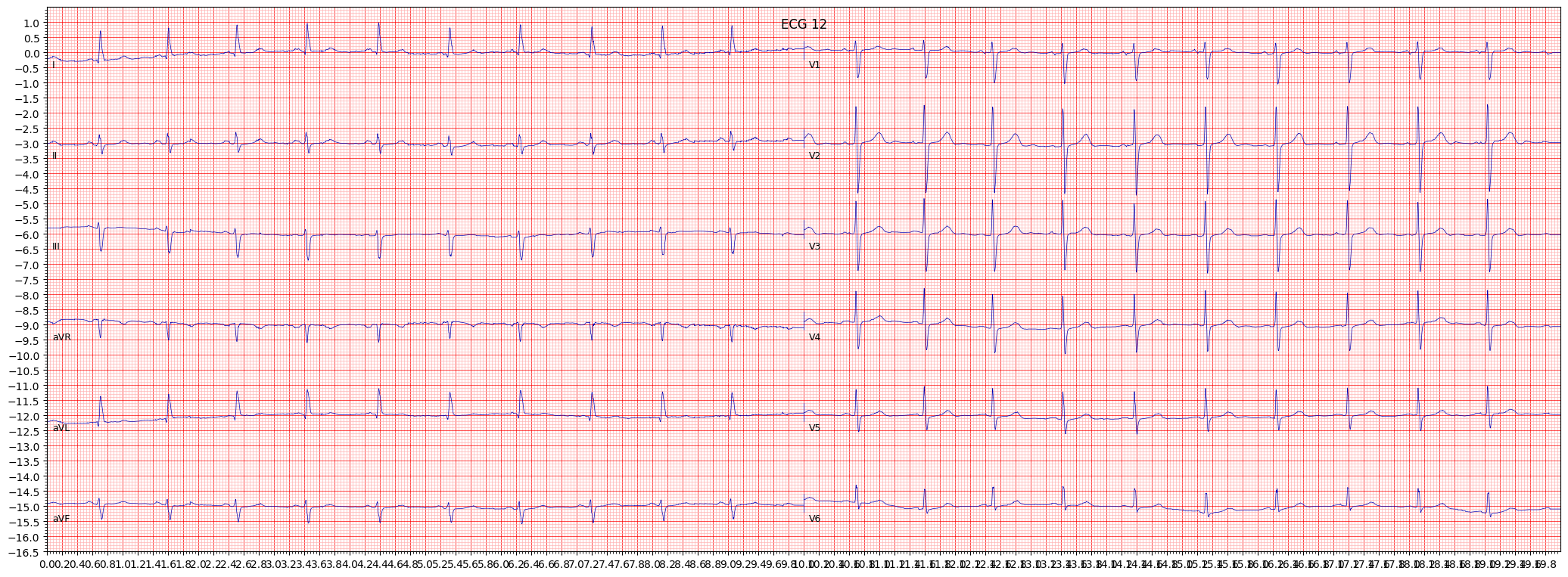 ECG example image