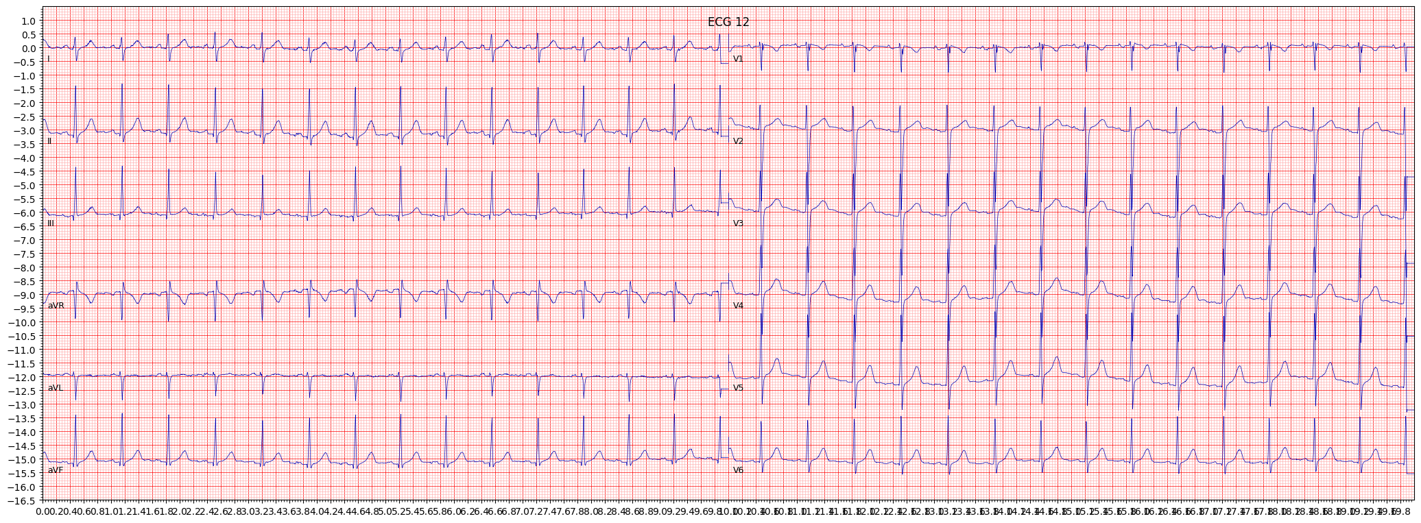 ECG example image