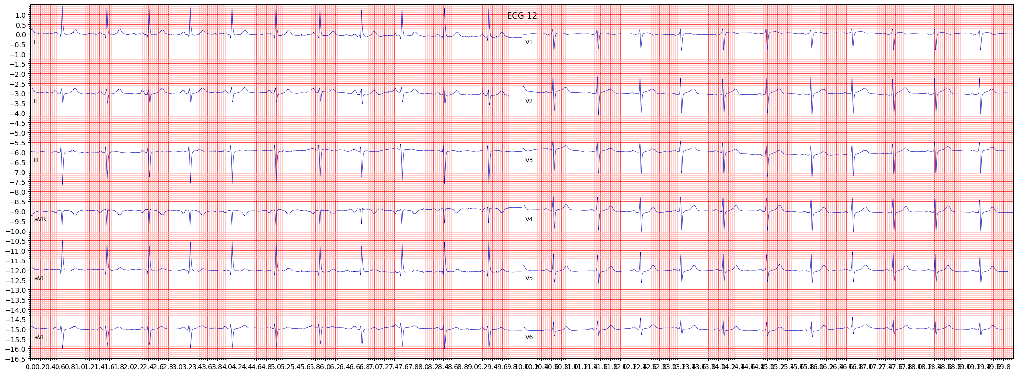 ECG example image