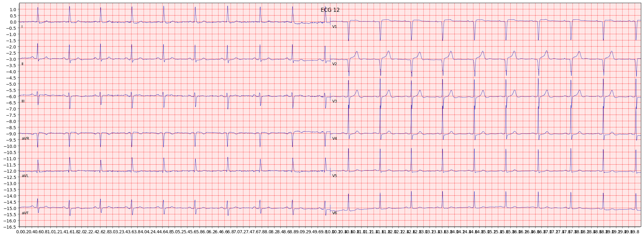 anterior myocardial infarction (AMI) example 16704