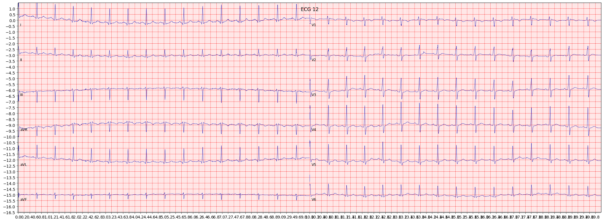 ECG example image