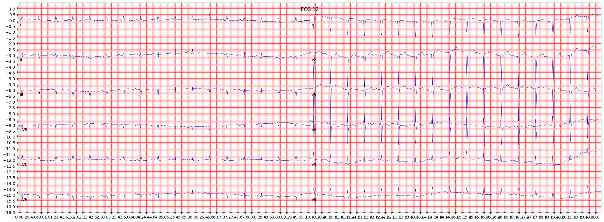 anteroseptal myocardial infarction (ASMI) example 1738