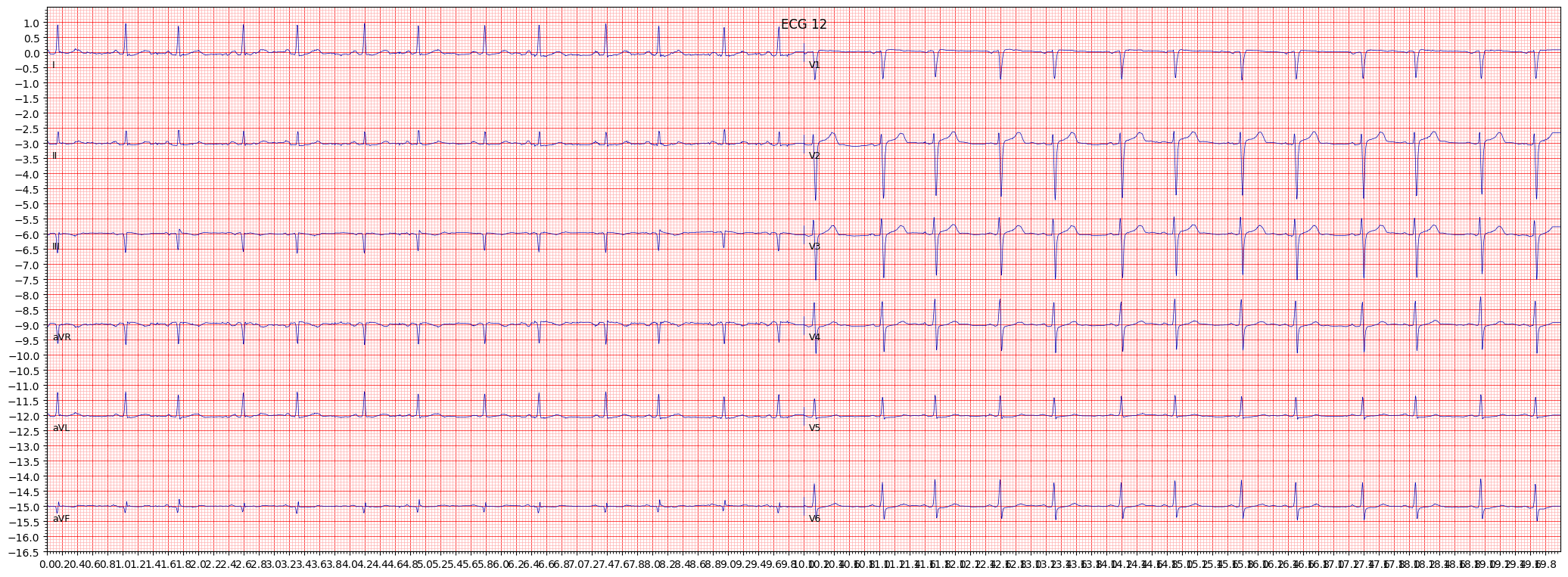 inferior myocardial infarction (IMI) example 1747