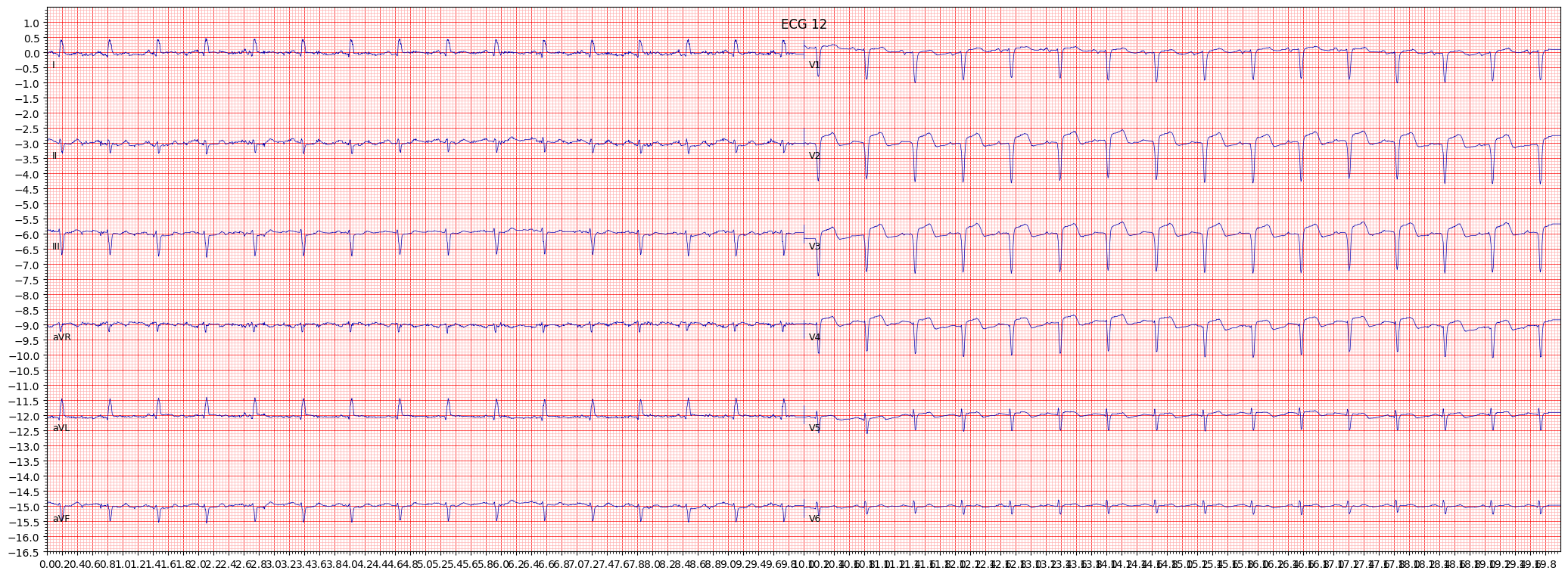 Examples of anteroseptal myocardial infarction (ASMI) | ECG Library