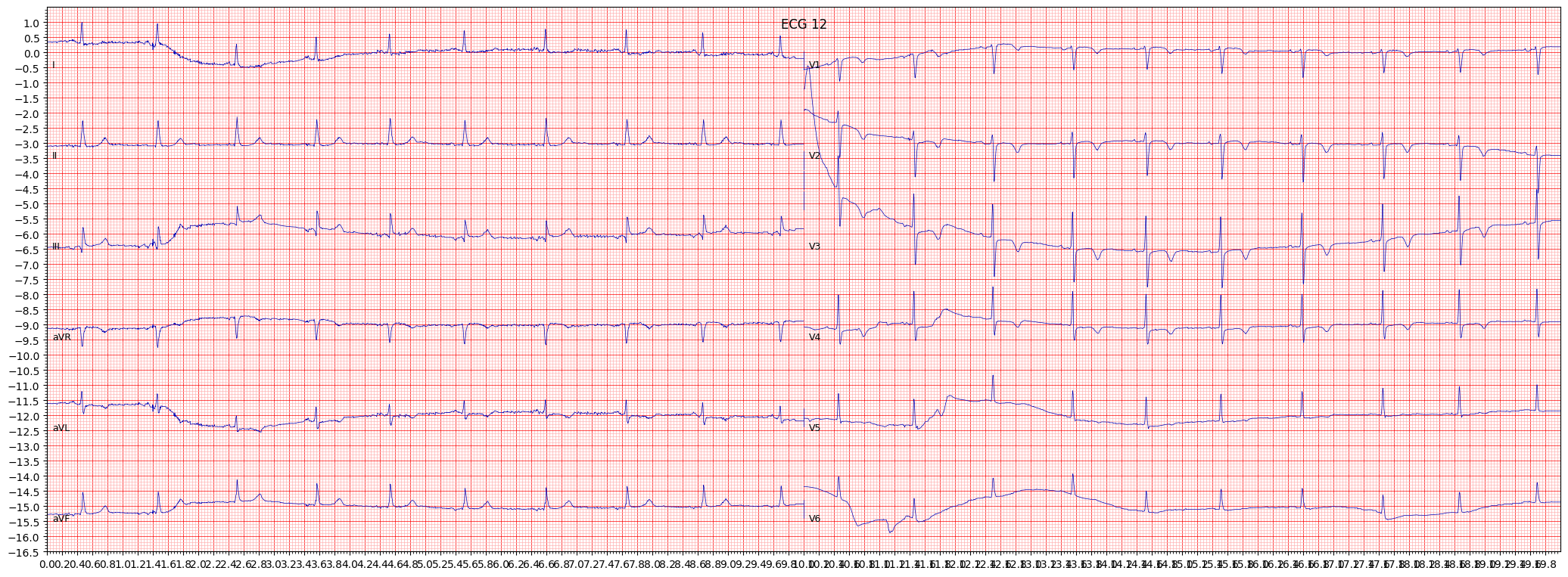 subendocardial injury in anteroseptal leads (INJAS) example 17869