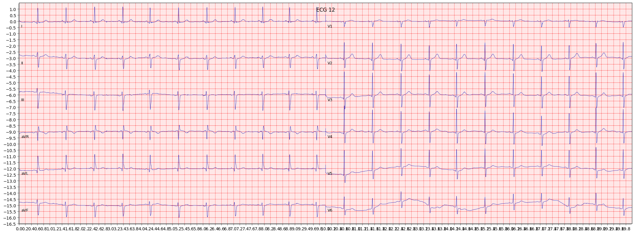 ECG example image