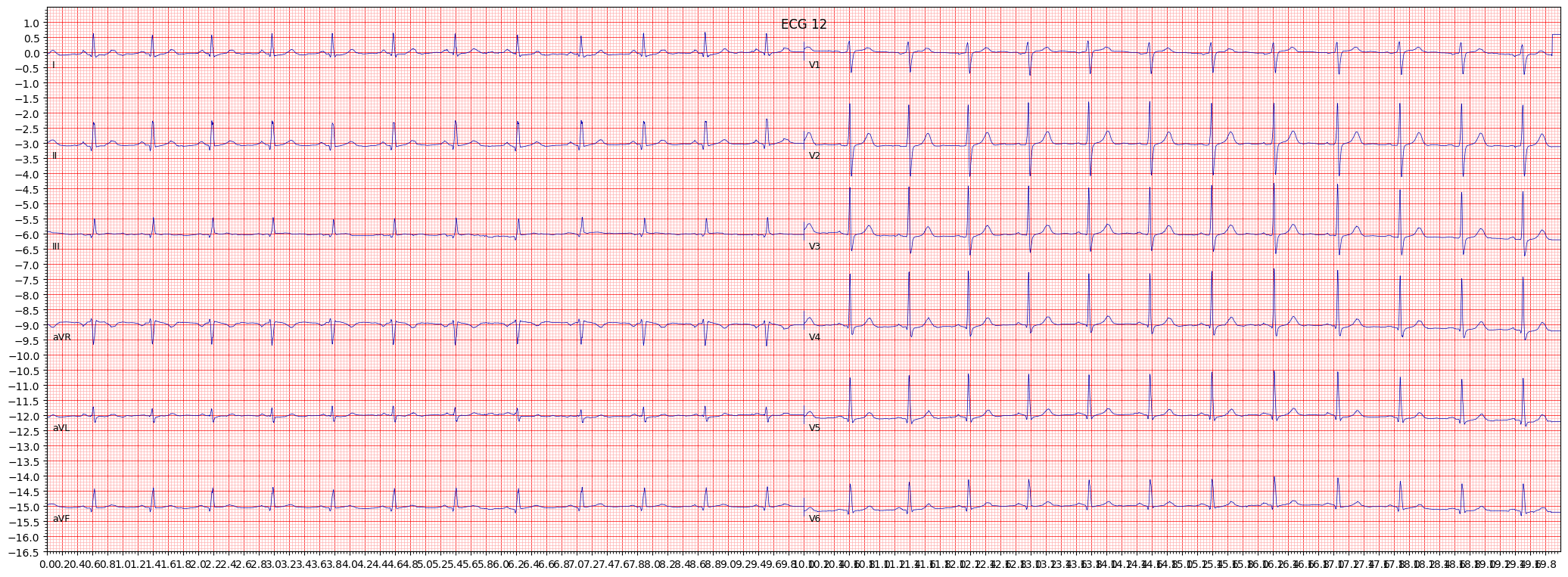 ECG example image