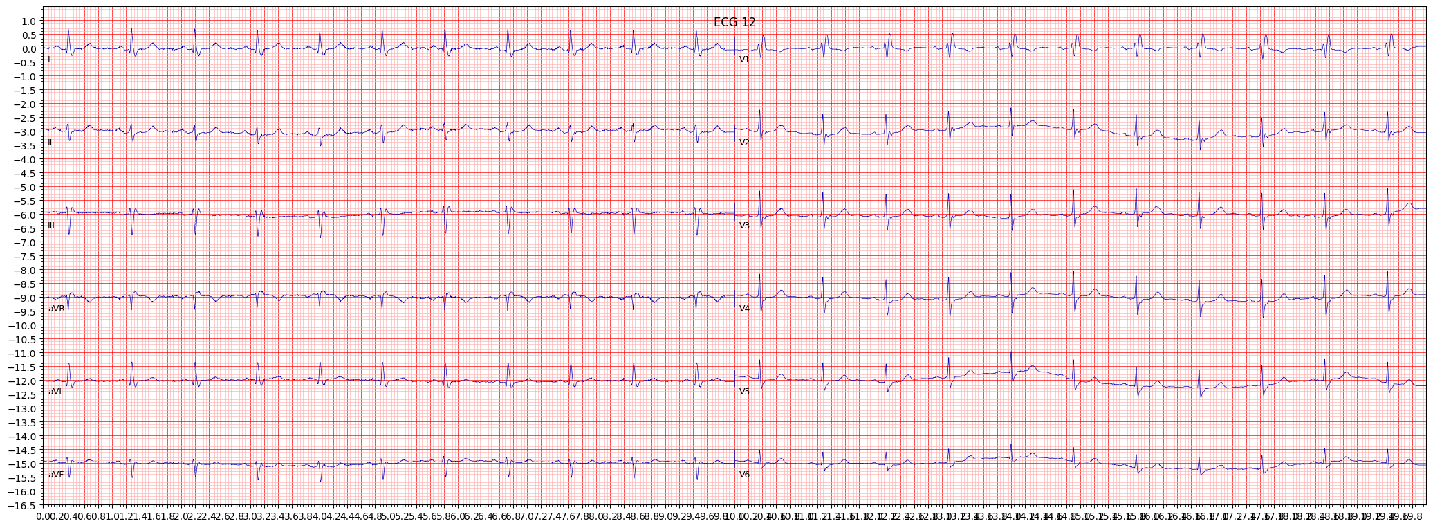 incomplete right bundle branch block (IRBBB) example 188