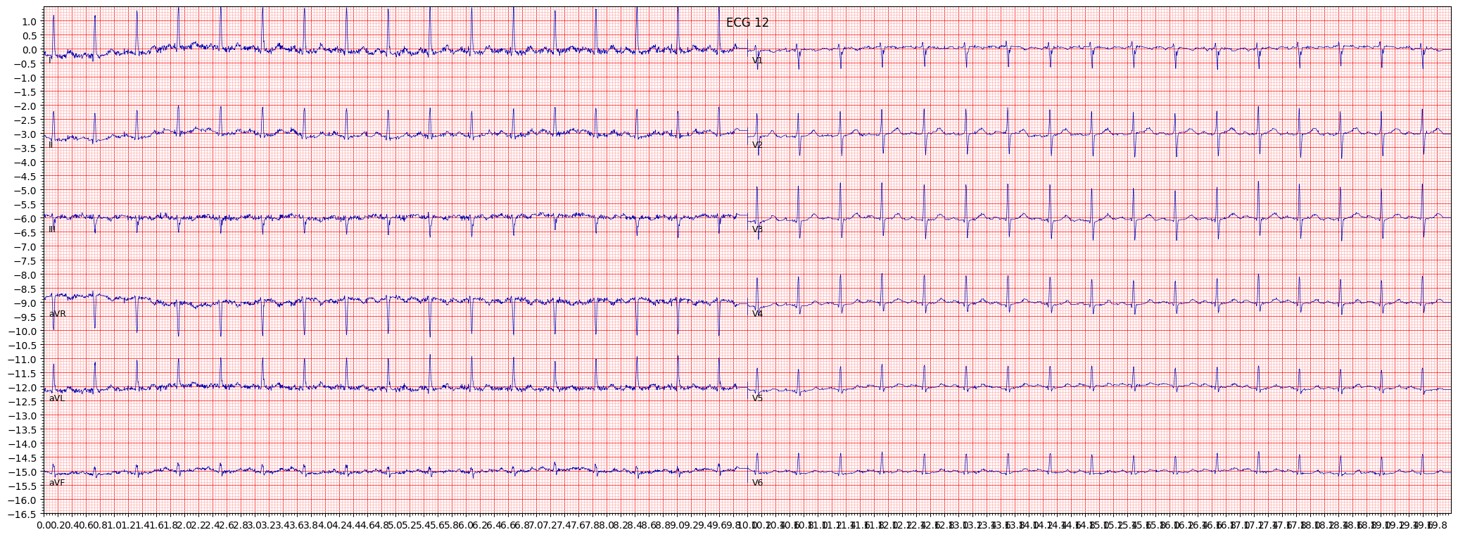 ECG example image