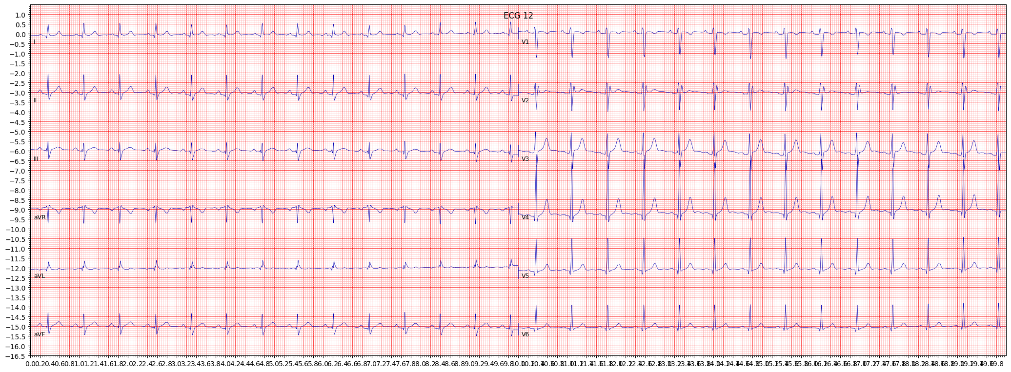 incomplete right bundle branch block (IRBBB) example 192