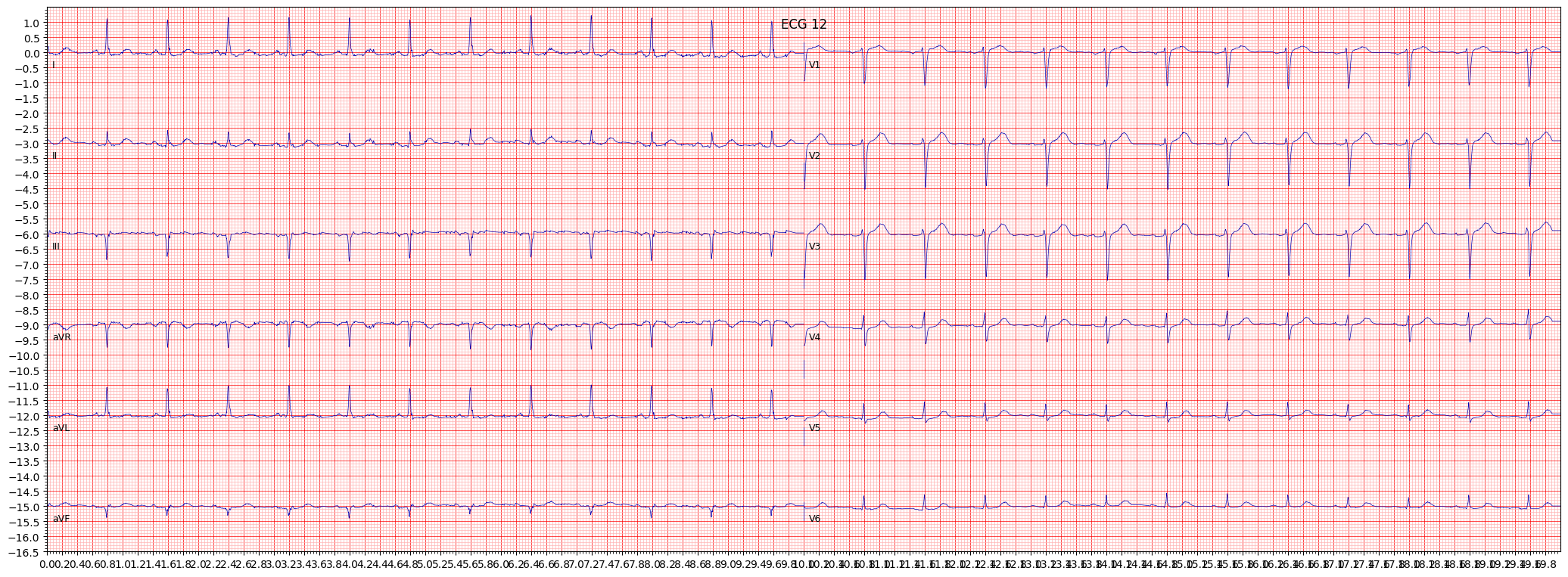 inferolateral myocardial infarction (ILMI) example 1935