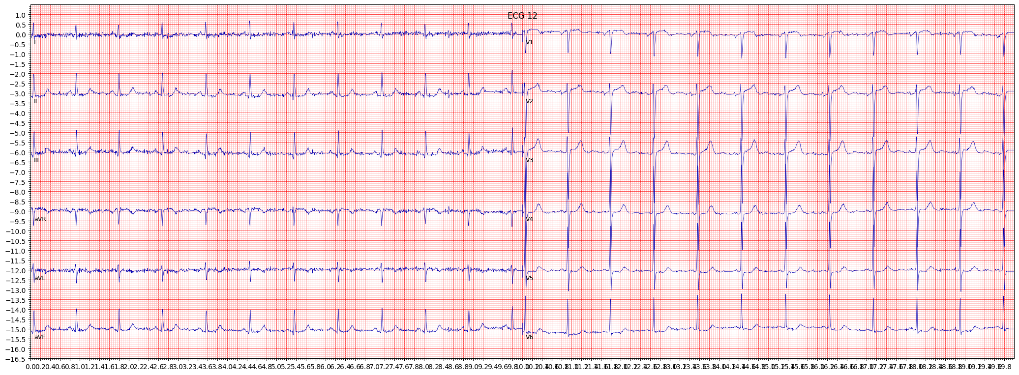 ECG example image