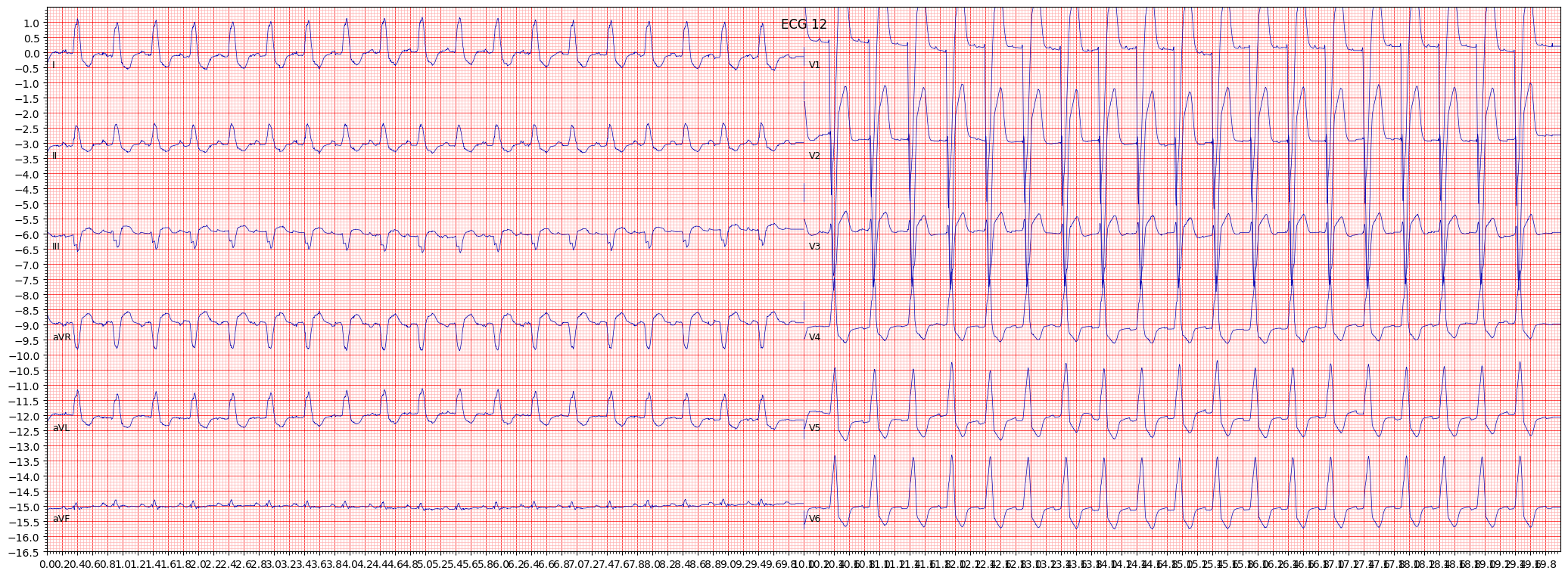 ECG example image